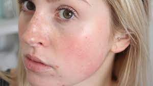 Mengatasi Wajah Rusak Akibat Skincare: Panduan Perbaikan Kulit yang Efektif