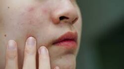 Skincare untuk Mengatasi Bruntusan dan Bekas Jerawat: Rahasia Kulit Wajah Bersih dan Mulus