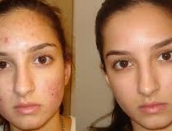 Skincare untuk Mengatasi Wajah Bruntusan dan Berminyak: Rahasia Kulit Sehat dan Bersinar