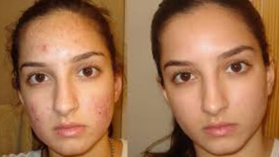 Skincare untuk Mengatasi Wajah Bruntusan dan Berminyak: Rahasia Kulit Sehat dan Bersinar