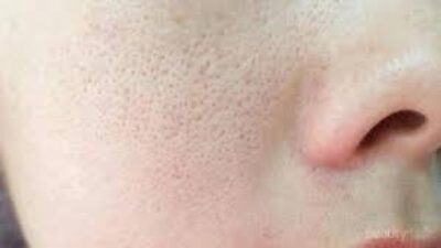 Skincare untuk Mengatasi Wajah Bruntusan dan Pori-Pori Besar: Rahasia Kulit Bersih dan Mulus